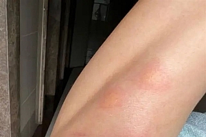 身上突然不明原因痒一下、又红又肿:不是蚊子咬的